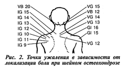 точки ужаления при остеохондрозе